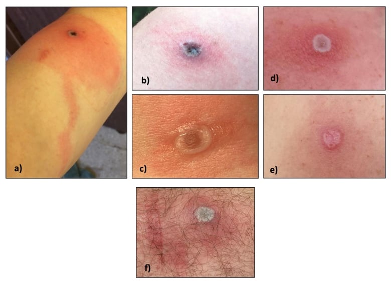 Image provided by the Alaska Department of Health shows a combination of photos of Alaskapox lesions. "A" is a lesion about 10 days after symptom onset, and "B" is the same lesion two days later. "C" is a lesion about 5 days after symptom onset, about 1.2 cm across. "D" is a lesion about 5 days after symptom onset, about 1 cm across, and "E" is same lesion about 4 weeks after symptom onset. "F" is a lesion around the reported symptom onset date.